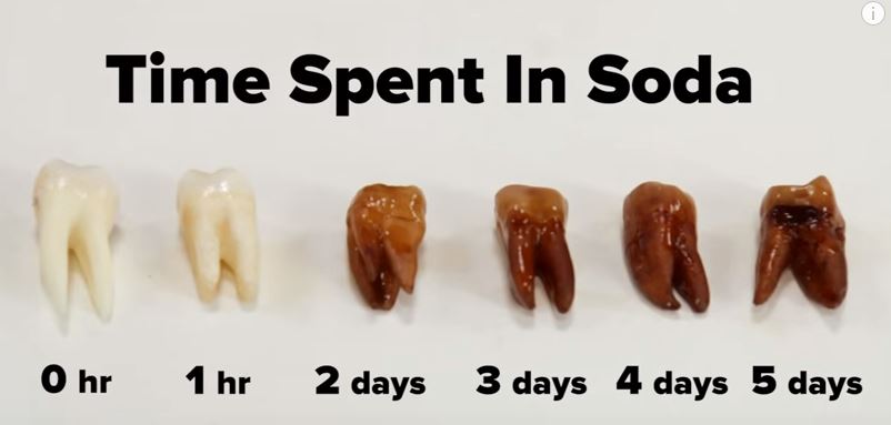 When Can You Have Carbonated Beverages After Tooth Extraction, Heres a Simple Timeline for You